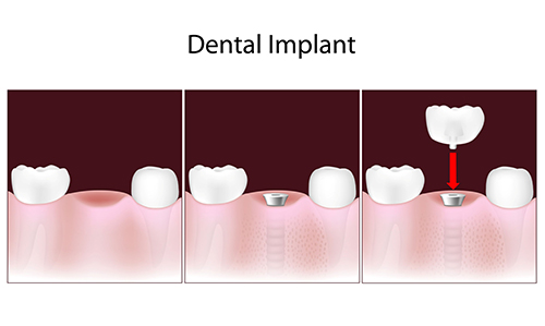 Dental Implants Brentwood