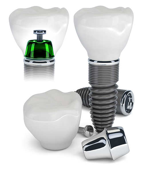 Dental Implants Bel Air